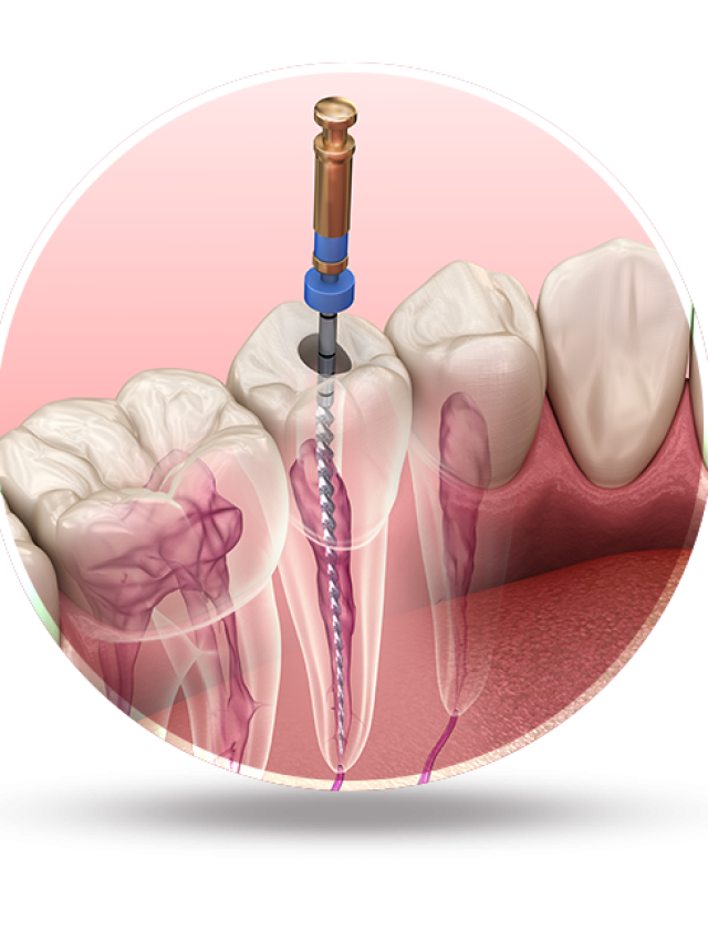 A root canal can sometimes save an injured tooth which may otherwise need extraction.