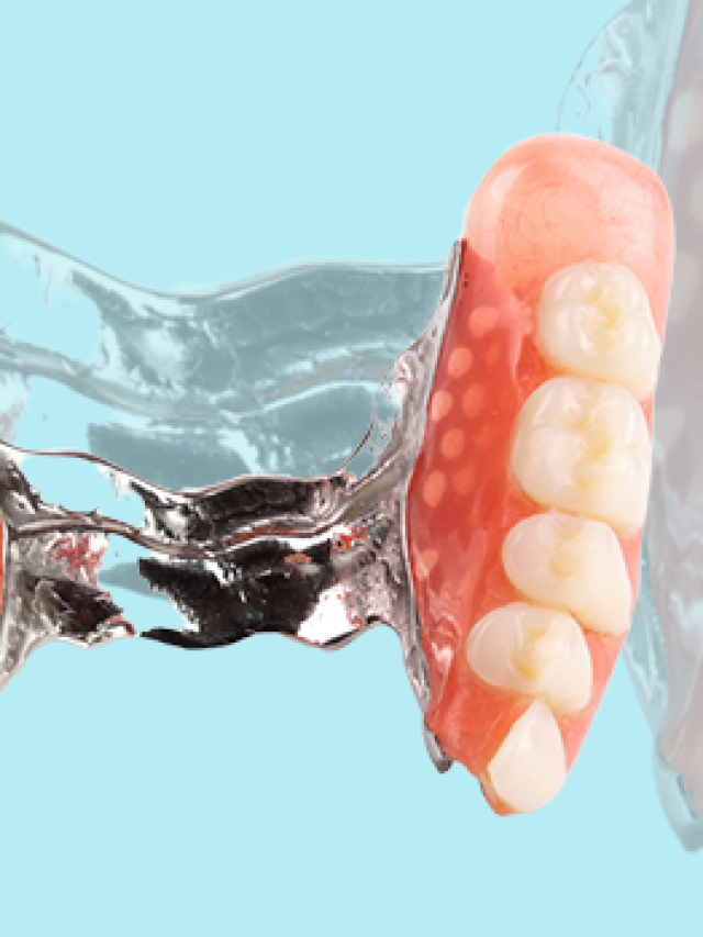 What to consider when choosing Partial Dentures