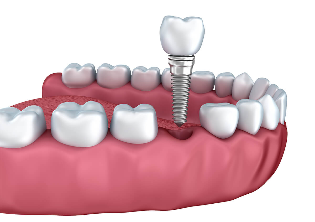Dental Implant Treatment in Surrey BC Area