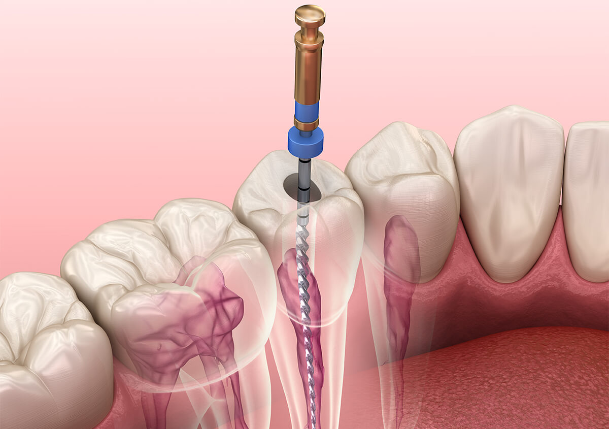 Root Canal Pain Relief in Surrey BC Area